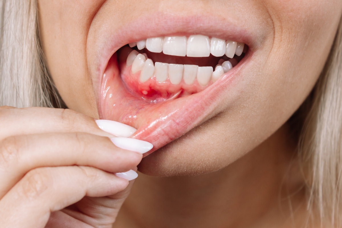 Diabetes and Gum Disease