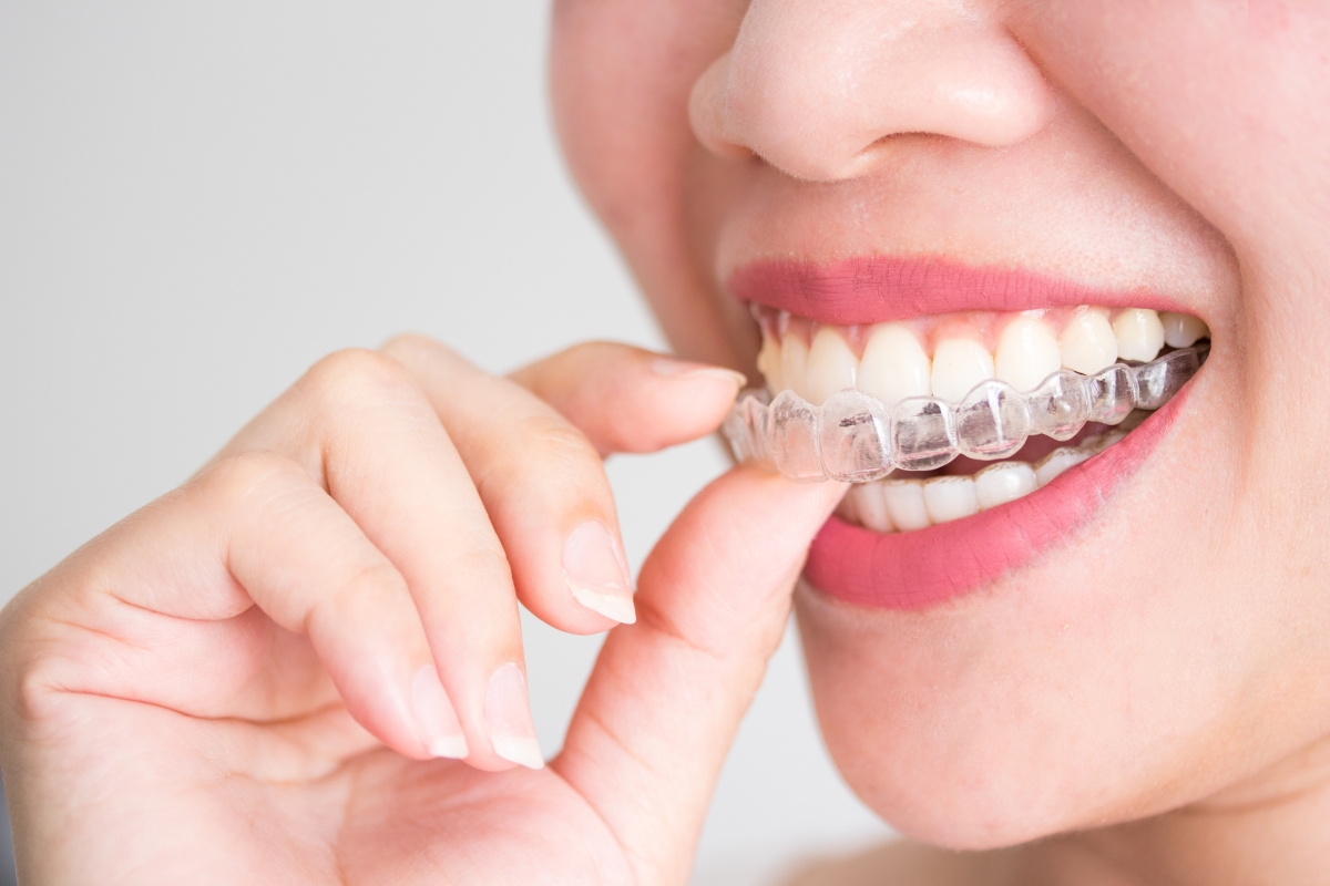 Invisalign-in-Spokane