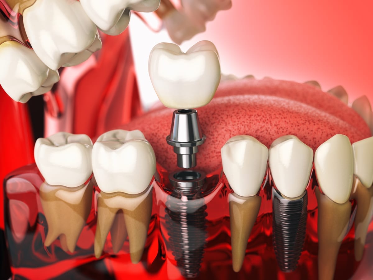 Dental Implants in Spokane